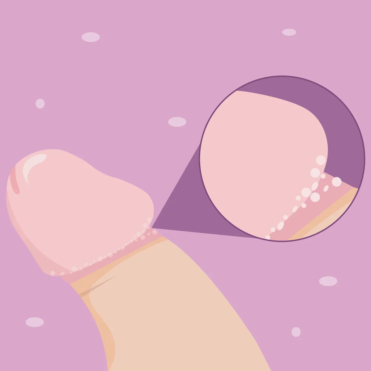 Tout savoir sur la couronne perlée (ou papules perlées) sur le pénis.