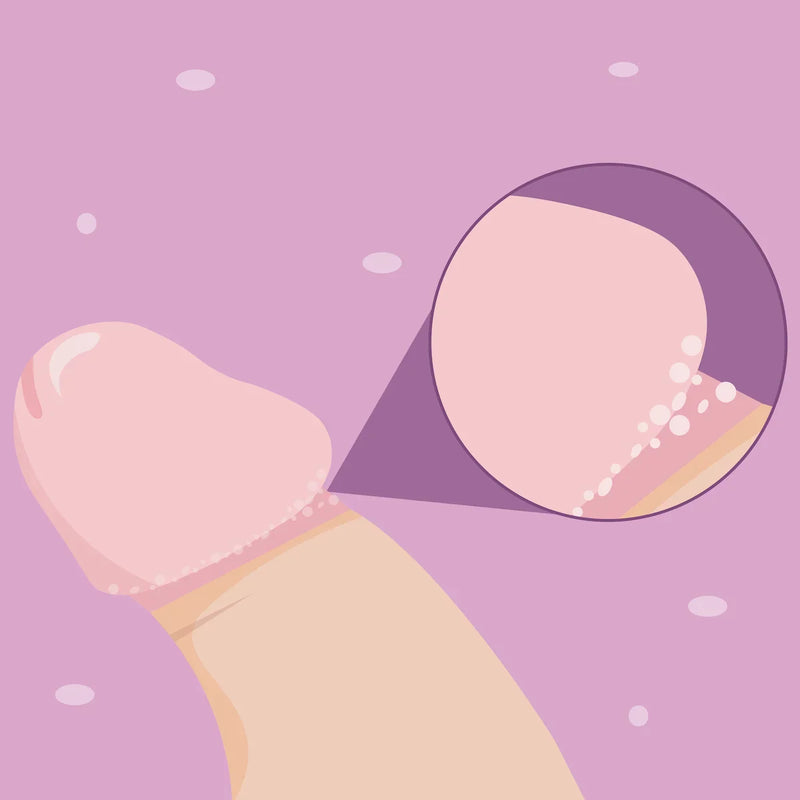 Tout savoir sur la couronne perlée (ou papules perlées) sur le pénis.